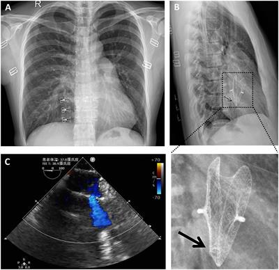 A Rare Ultra-Long-Term Complication of Occluder Recanalization Due to Spontaneous Perforation of Polyvinyl Alcohol Membrane of Atrial Septal Defect Occluder: A Case Report and Review of the Literature